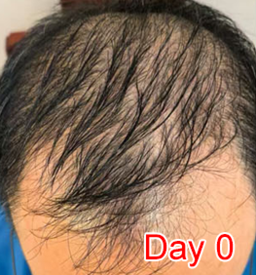Day 0
