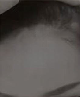 斑秃